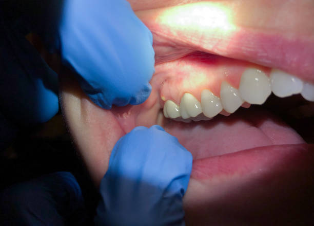 Best Emergency Treatment for Oral Infections in Rocklin, CA